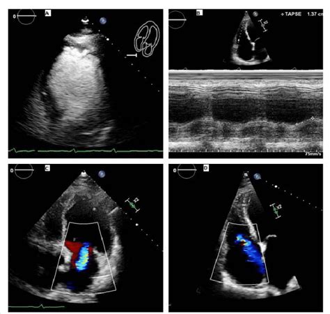 what is hypokinesis on echocardiogram.